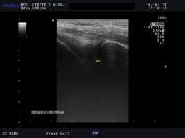 Ultrazvok kolena - možna poškodba meniska 2